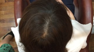 前髪やつむじのパカっと割れが直るとしたらどうします?
